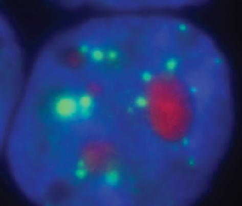 Amyloid Plaques