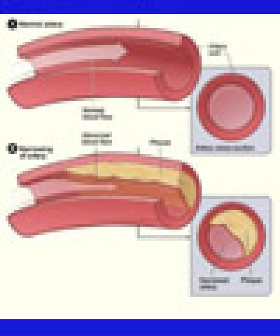 Angiogram Enigma