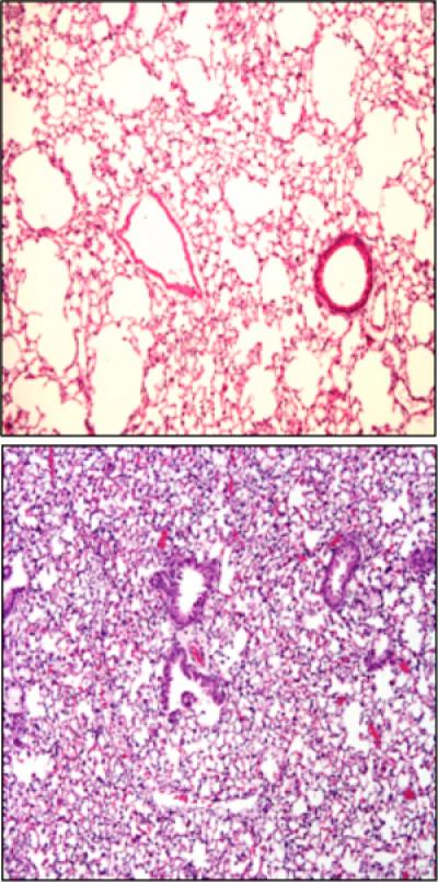 Acute Lung Injury