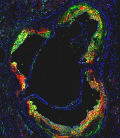 Novel Statin Nanotherapy