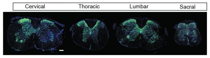 Early Treatment with Approved Drug May Alleviate Muscle Spasms in Spinal Cord Injury Patients (1 of 2)