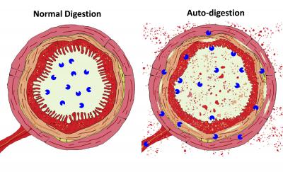 'Self-Eating' Digestive Enzymes Linked to Shock, Organ Failure (3 of 3)
