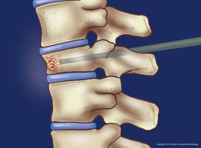 Vertebroplasty
