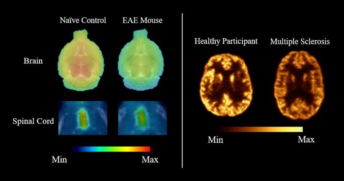 Representative SV2A PET images comparing synaptic density in healthy and disease states.