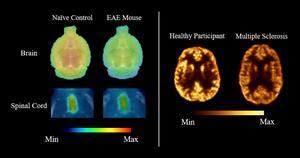 Representative SV2A PET images comparing synaptic density in healthy and disease states.