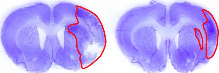 Stroke Damage