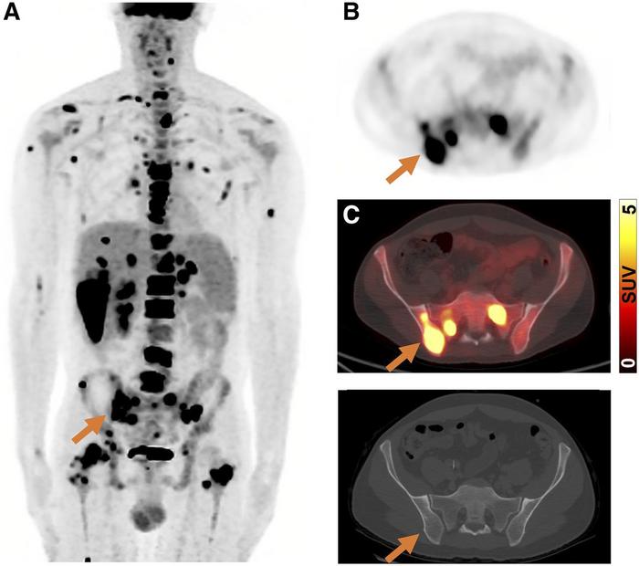 Patient with 18F-FDG avid nodal and extranodal metastatic disease.