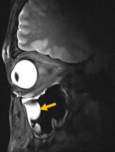 High-resolution 7.0 T MRI of the eye and orbit
