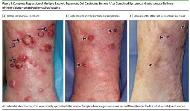 Sylvester Researcher Uses HPV Vaccine to Treat Patient with Skin Cancer