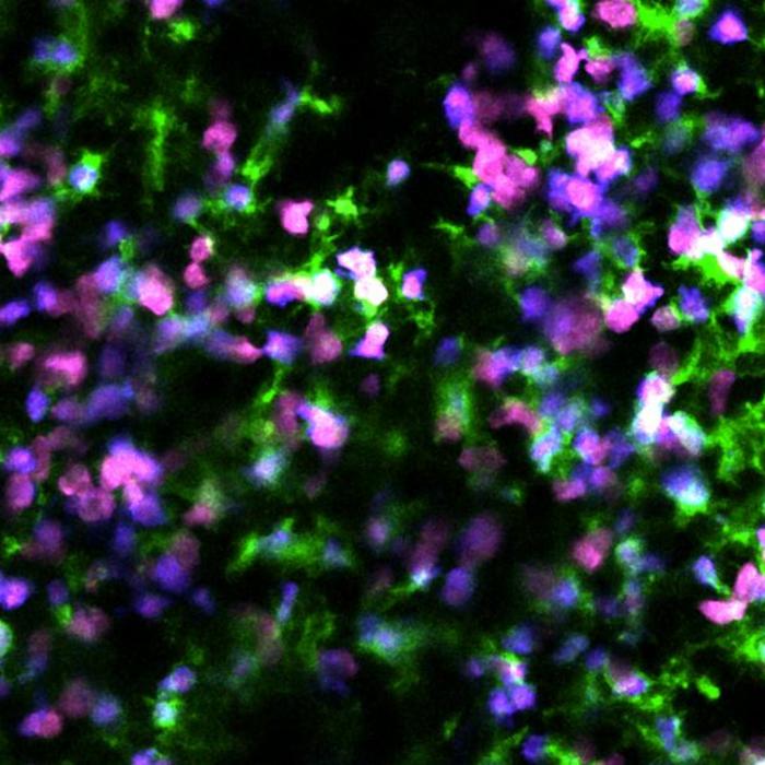 Observation of cancer cell death in a preclinical model using in vivo two-photon imaging. In magenta, living cancer cells ; in blue, dying cancer cells ; in green, macrophages