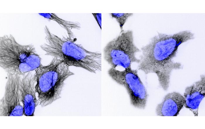 Neuroblastoma cells under the microscope