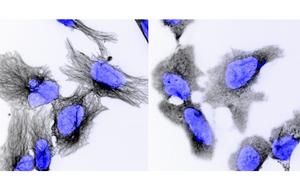Neuroblastoma cells under the microscope