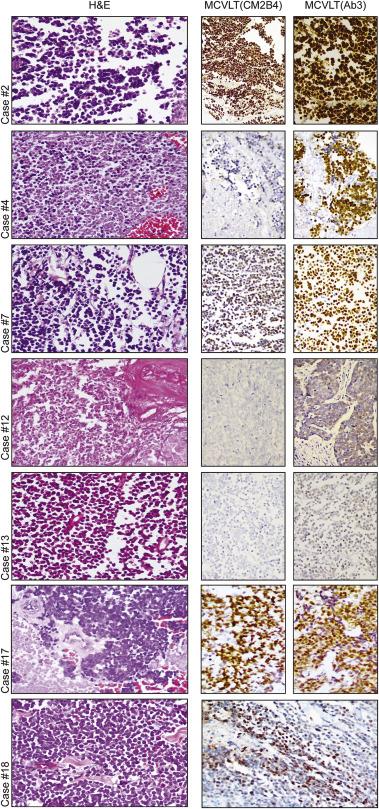 Merkel Cell Polyomavirus Positive Merkel Cell Carcinoma