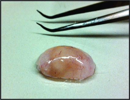 Implant Removed