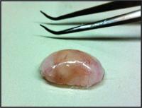 Implant Removed