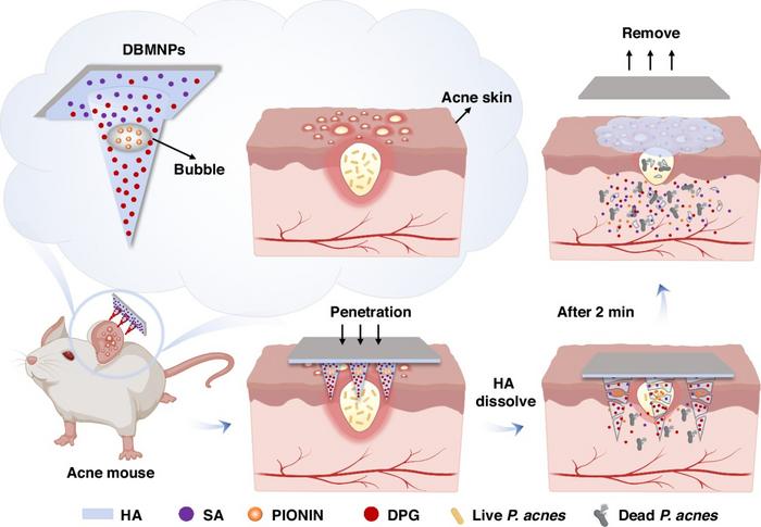 Schematic illustration of DBMNPs for acne treatment.
