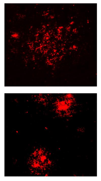 Beta Amyloid Plaque