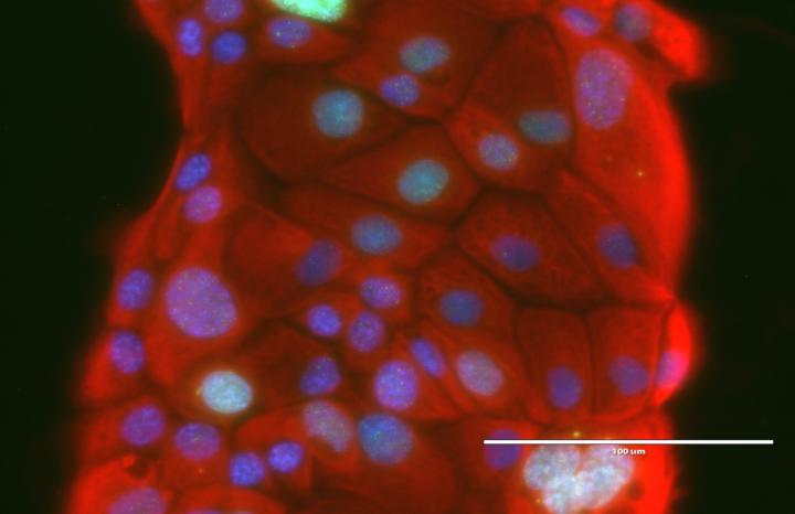 Pancreatic Cancer Patient-Derived Cell Lines