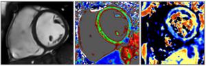 Cardiac MRI images