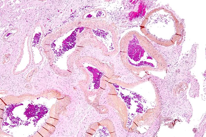KRAS Gene: A Key Driver for Brain Arteriovenous Malformation