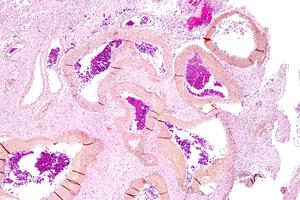 KRAS Gene: A Key Driver for Brain Arteriovenous Malformation