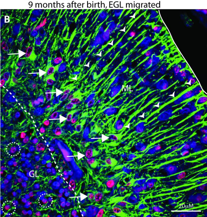 Prognostic Marker for Childhood Brain Cancer Uncovered (2 of 2)