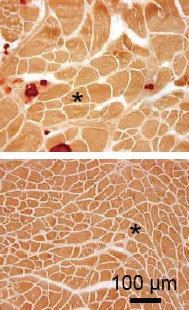 AAV Micro-Dystrophin Gene Therapy