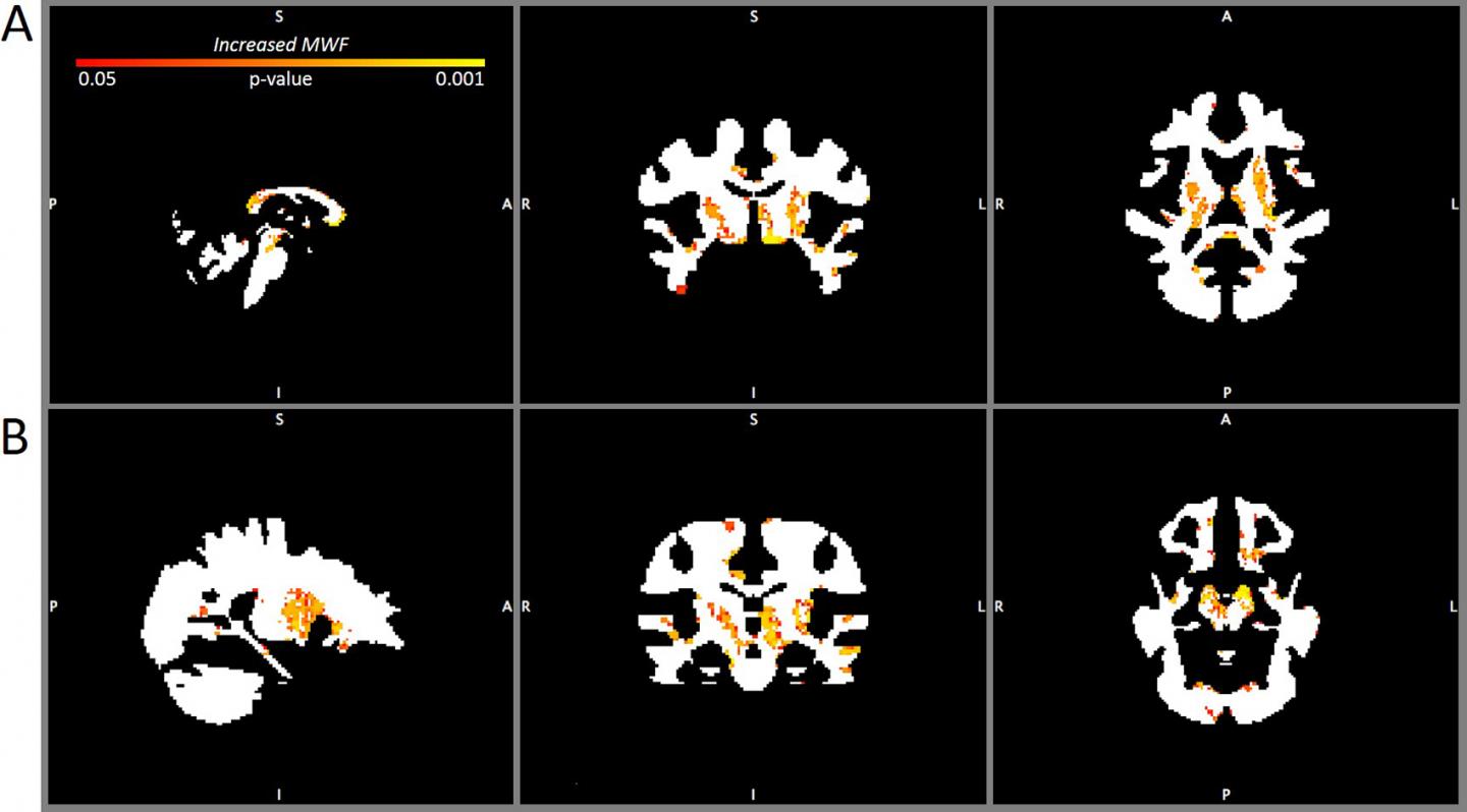 Myelin Water Fraction Map