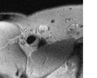Cholesterol Plaque