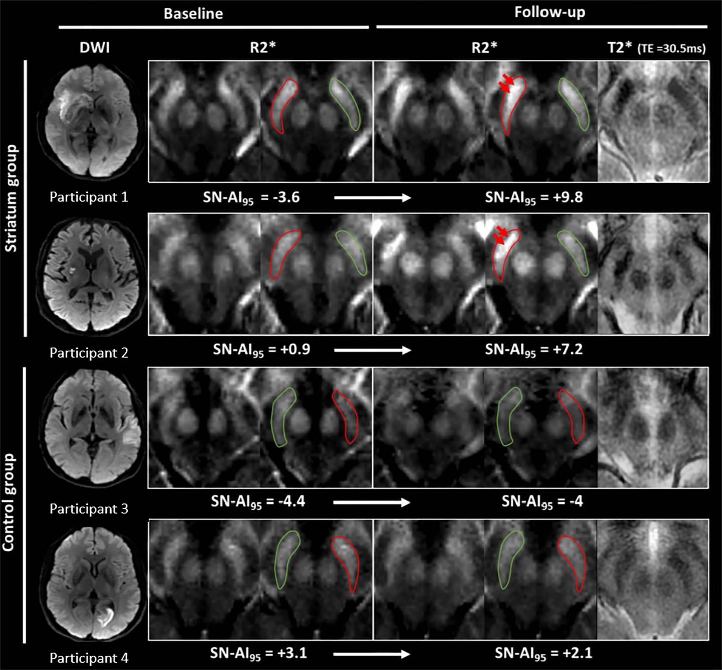 Iron Measurements with MRI Reveal Stroke's Impact on Brain (1 of 3)