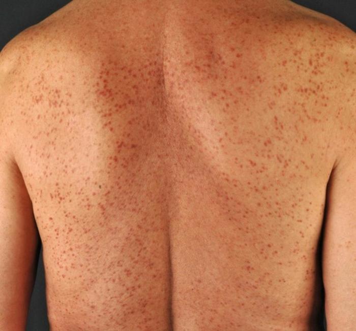 Typical skin lesions in mastocytosis