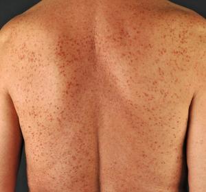 Typical skin lesions in mastocytosis