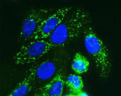 Cancer Cell Metabolism Kills