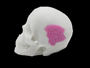 A new bone substitute made out of … 3D-printed glass?