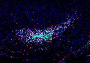 An immune cell aggregate known as a tertiary lymphoid structure located within a pancreatic cancer as a result of treatment with activated T cell extracellular vesicle DNA and immune checkpoint blockade.