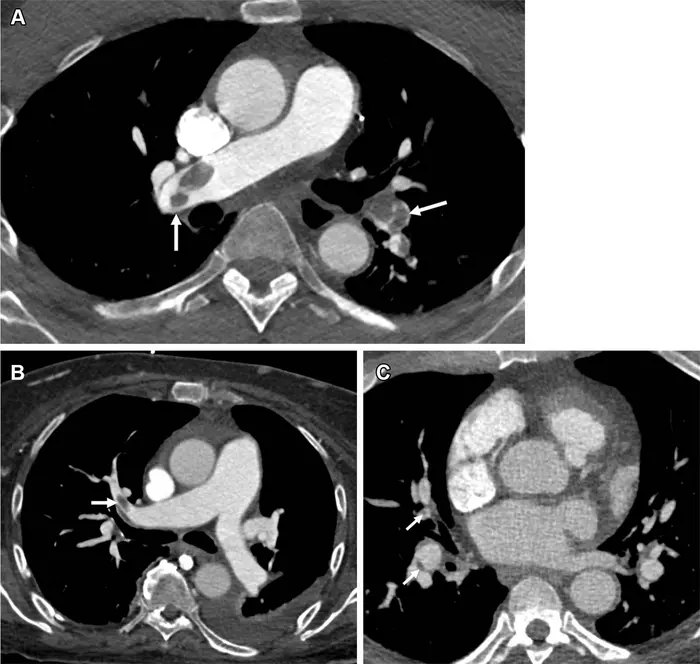 Stages of thromboembolism