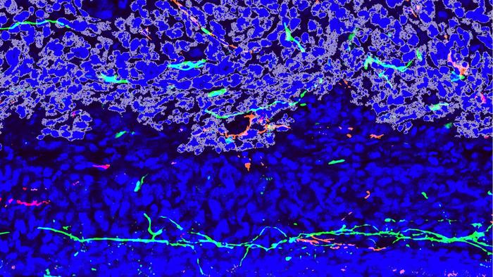 Osteosarcoma invading normal bone