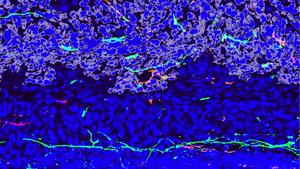 Osteosarcoma invading normal bone