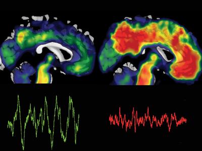 Buildup of Toxic Proteins Found in Alzheimer's Linked to Lack of Sleep