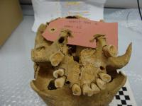 Teeth from the Middle Ages (1 of 2)