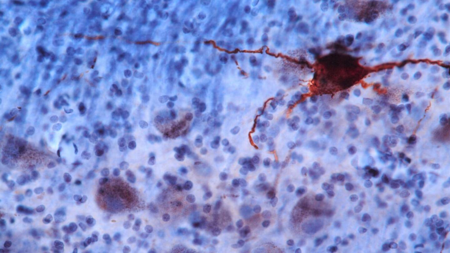 Alzheimer's Neuron