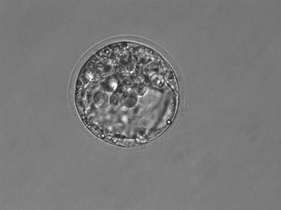 In vitro Fertilization
