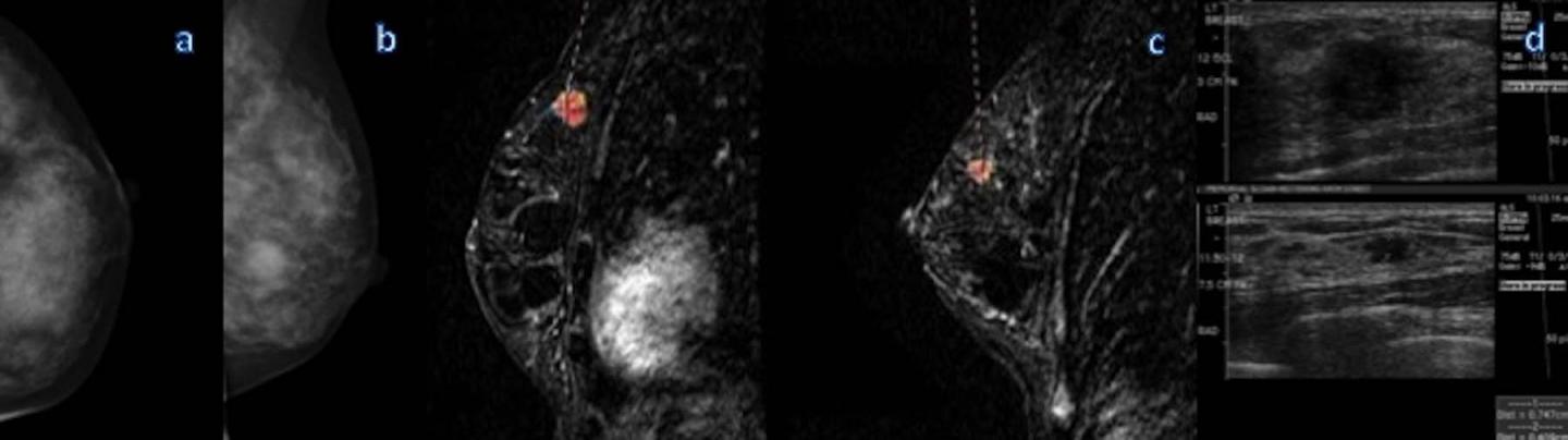 Mammography