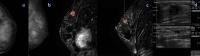 Mammography