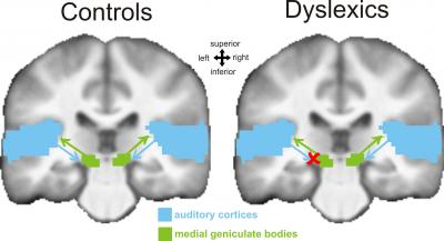 Brain Dyslexia