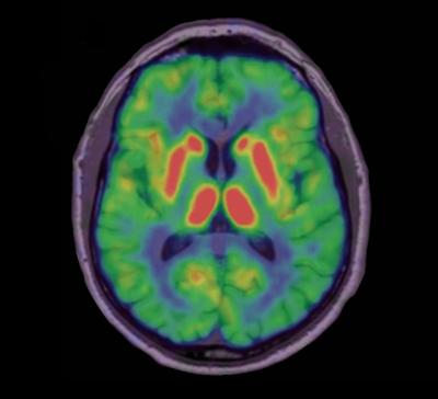 Serotonin Solves Decades-Old Mystery in Parkinson's Disease (2 of 4)