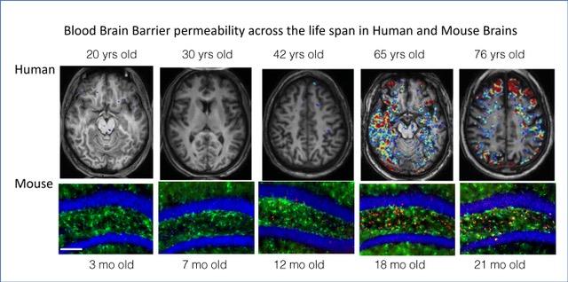 With Age, Blood-Brain Barriers Becomes Leaky
