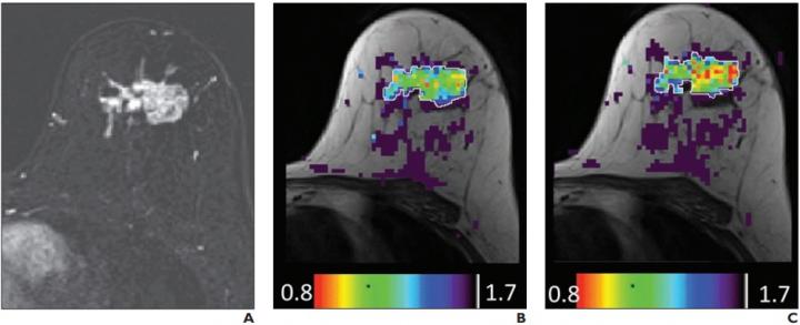 61-Year-Old Woman With Grade 3 Invasive Ductal Carcinoma
