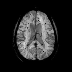 Brain Bleeds