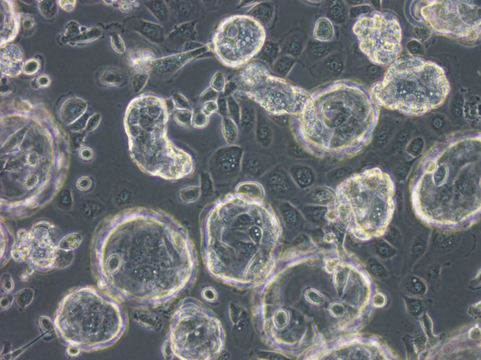 Local Study Demonstrates Synergies of Using Blood-based Liquid Biopsies to Complement Tissue Biopsies for Lung Cancer Diagnosis